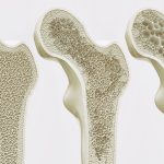 Rahasia Tulang Kuat: Kombinasi Makanan dan Gaya Hidup yang Tepat