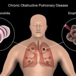 7 Tips Mencegah Penyakit Paru Obstruktif Kronik Sejak Dini