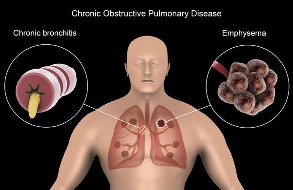 7 Tips Mencegah Penyakit Paru Obstruktif Kronik Sejak Dini