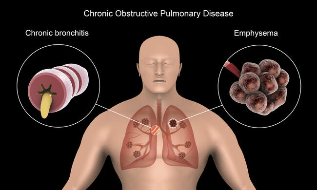 7 Tips Mencegah Penyakit Paru Obstruktif Kronik Sejak Dini
