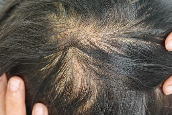 5 Tips Menutrisi Rambut agar Tumbuh Lebih Cepat dan Sehat
