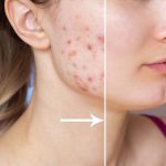 7 Langkah Mudah untuk Menghilangkan Bekas Jerawat