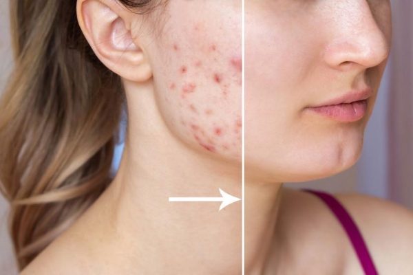 7 Langkah Mudah untuk Menghilangkan Bekas Jerawat