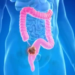 5 Cara Mengurangi Risiko Kanker Usus