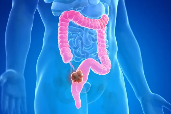 5 Cara Mengurangi Risiko Kanker Usus 5 Cara Mengurangi Risiko Kanker Usus