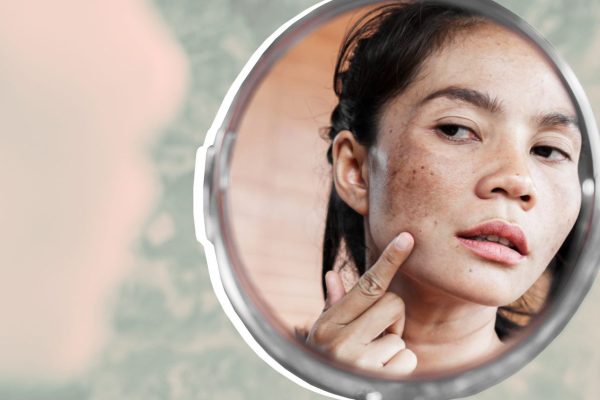 7 Cara Alami Menghilangkan Flek Hitam di Dagu 7 Cara Alami Menghilangkan Flek Hitam di Dagu