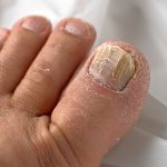 7 Langkah Mudah untuk Mengatasi Jamur Kuku Kaki