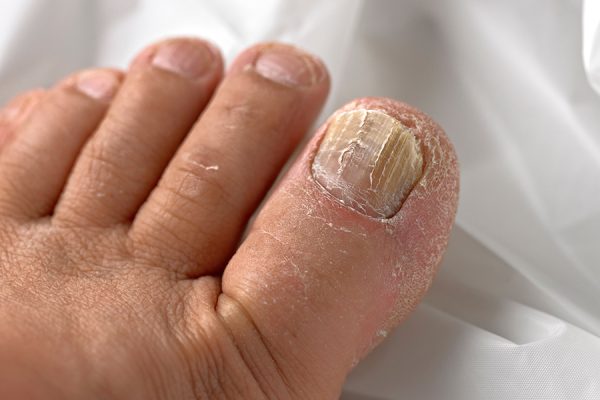 7 Langkah Mudah untuk Mengatasi Jamur Kuku Kaki