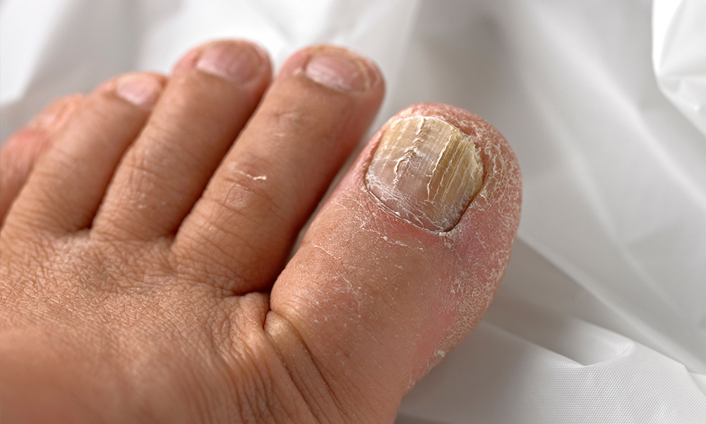 7 Langkah Mudah untuk Mengatasi Jamur Kuku Kaki
