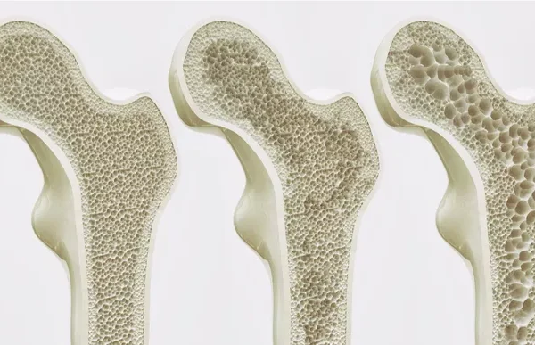 7 Cara Cegah Osteoporosis Sejak Muda