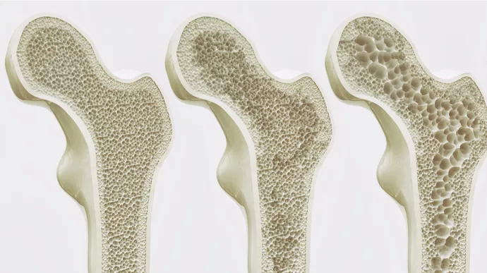 7 Cara Cegah Osteoporosis Sejak Muda