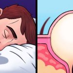 10 Kebiasaan Sehari-hari yang Diam-diam Menyebabkan Jerawat