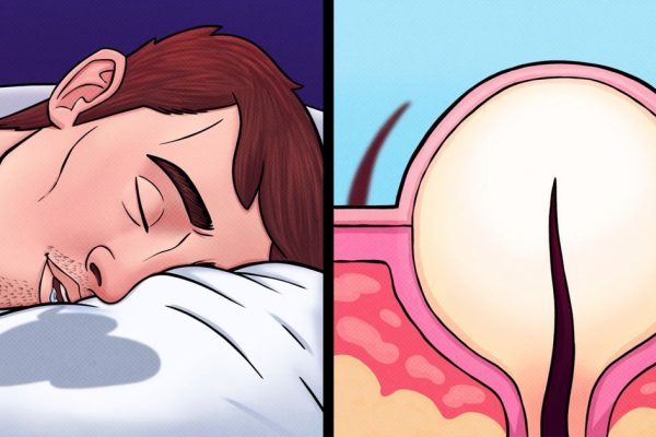 10 Kebiasaan Sehari-hari yang Diam-diam Menyebabkan Jerawat