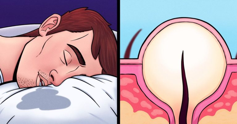 10 Kebiasaan Sehari-hari yang Diam-diam Menyebabkan Jerawat