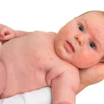 10 Cara Mengurangi Risiko Alergi pada Bayi Baru Lahir