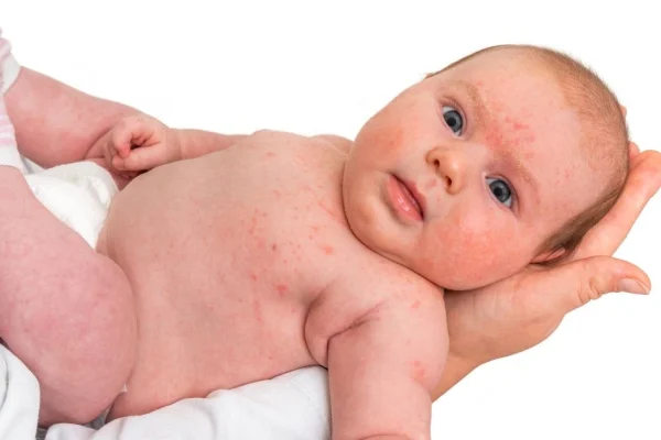10 Cara Mengurangi Risiko Alergi pada Bayi Baru Lahir 10 Cara Mengurangi Risiko Alergi pada Bayi Baru Lahir