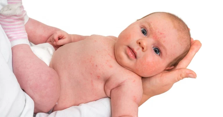 10 Cara Mengurangi Risiko Alergi pada Bayi Baru Lahir