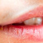 10 Penyebab Bibir Kering yang Sering Diabaikan