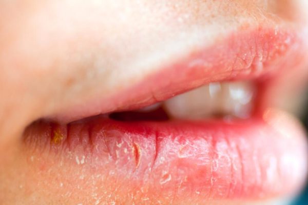 10 Penyebab Bibir Kering yang Sering Diabaikan 10 Penyebab Bibir Kering yang Sering Diabaikan