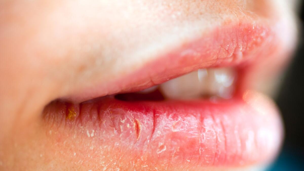 10 Penyebab Bibir Kering yang Sering Diabaikan