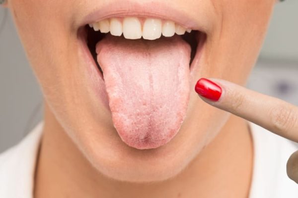 7 Cara Mendeteksi Masalah Kesehatan dari Warna Lidah