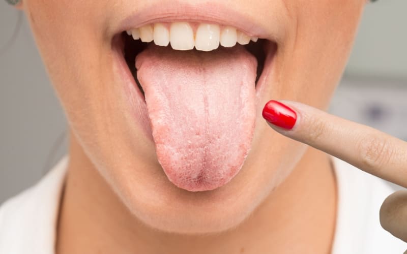 7 Cara Mendeteksi Masalah Kesehatan dari Warna Lidah